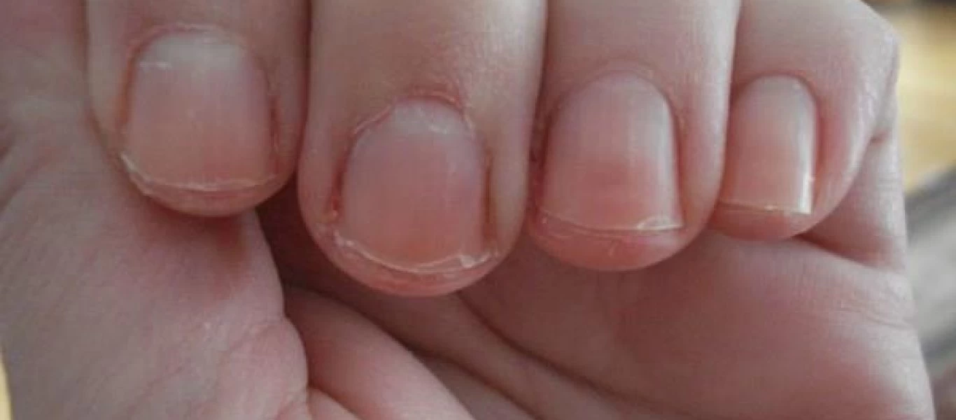 Πέντε ύπουλα προβλήματα υγείας που φαίνονται στα νύχια